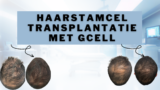 Haarstamceltransplantatie met Gcell